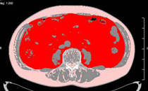 内臓脂肪の図：3画像